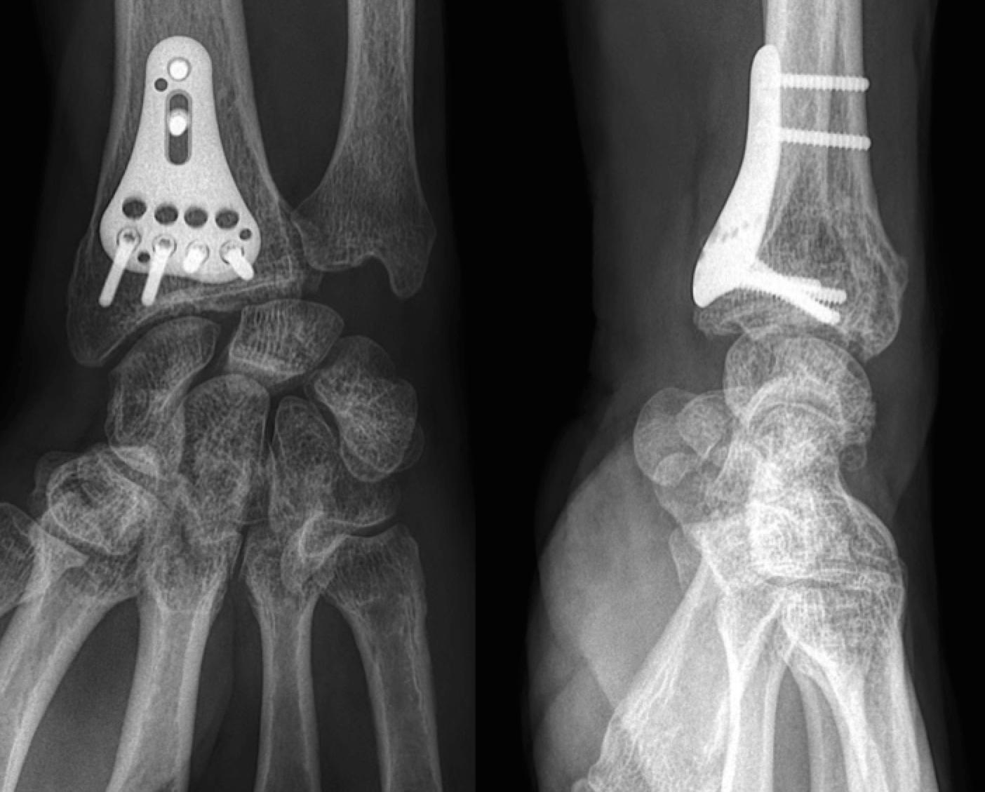 Fracture du Clinique Ostéo Articulaire des Cèdres Grenoble